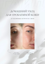 ГАЙД ПО УХОДУ ЗА ПРОБЛЕМНОЙ КОЖЕЙ